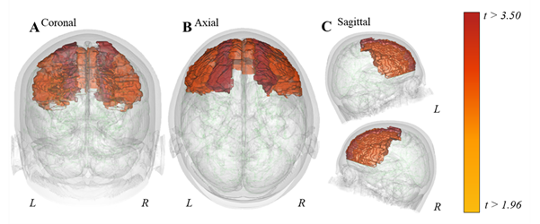 Increased thickness of the frontal and superior frontal cortex seen in children with ARFID symptoms relative to children not presenting with ARFID symptomatology]